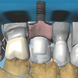 Compatibilidad con múltiples escáneres dentales